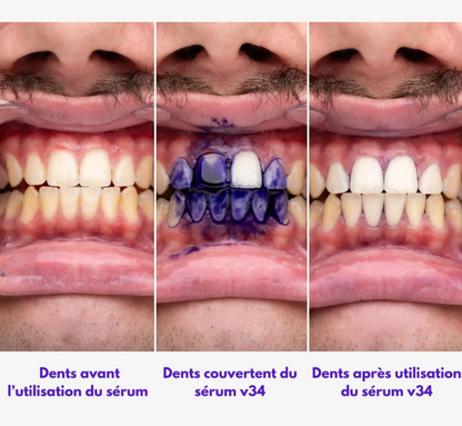 Sérum Correcteur violet blanchiment des dents