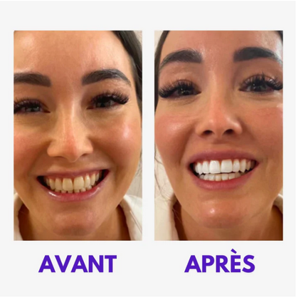Sérum Correcteur violet blanchiment des dents